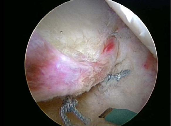 tear, and a fracture of the posterior rim of the acetabulum. At that time, an intra-articularly injected anesthetic provided pain relief.