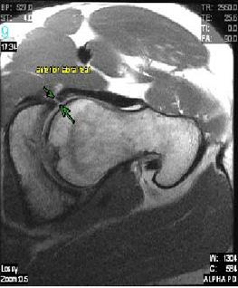 M. B. Berkes et al A Figure 7. Case 2 axial (A) and sagittal (B) magnetic resonance imaging shows nonunion of posterior rim acetabulum fracture and tear of anterior labrum. cular necrosis.