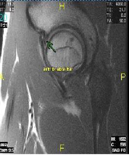 A nonunited posterior acetabular rim fracture with attached labrum was also appreciated.