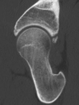 Excellent clearance was achieved with both arthroscopic and fluoroscopic dynamic examination, but some posterior subluxation was noted with hip flexion beyond 50. B Figure 8.
