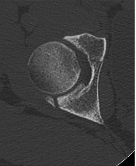 Case 3 axial (A) and oblique (B) computed tomography shows posterior acetabular rim fracture and nonunion. After surgery, physical therapy was initiated with progressive weight-bearing and ROM.
