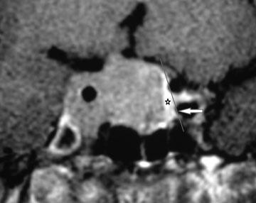 42 MRI to Predict Parasellar Adenoma Excision Connor et al. Postoperative magnetic resonance imaging (MRI) is used to detect such residual parasellar tumor.