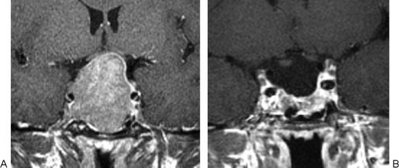 A two-sample Wilcoxon rank sum test was performed to assess the correlation between the degree of intracavernous ICA encasement and complete resection versus potential residual tumor. Fig.