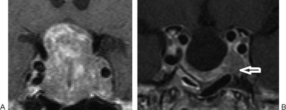 44 MRI to Predict Parasellar Adenoma Excision Connor et al. Fig. 5 Gadolinium-enhanced coronal images (A) pre-resection and (B) 3 months postresection.