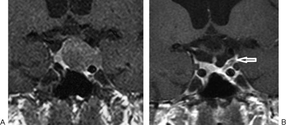 enhancement characteristics. Fig. 6 Gadolinium-enhanced coronal images (A) pre-resection and (B) 3 months postresection.