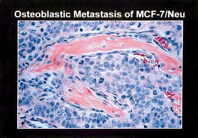 Bisphosphonate Actions on Bone Metastasis/Yoneda et al. 2985 and diminished metastatic tumor burden in bone.