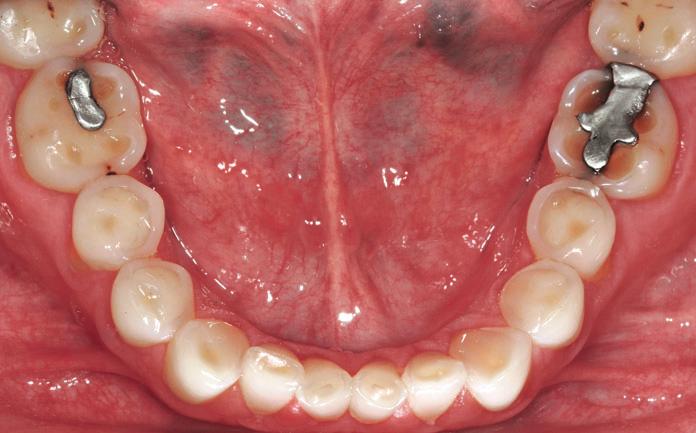 CLINICAL APPLICATION Puliction Full-Mouth Adhesive Rehilittion of Severely Eroded Dentition: The Three-Step Technique. Prt 2.
