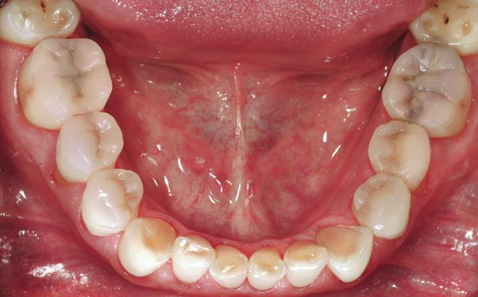 VAILATI/BELSER Puliction Astrct Trditionlly, full-mouth rehilittion sed on full-crown coverge hs een recommended tretment ptients ffected severe dentl erosion.