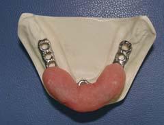 Comprison of Retentive Force in Four Attchment Systems in Implnt- Supported Overdenture Ahmdzdeh A. insurnce.