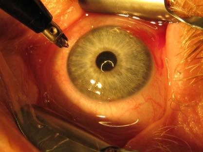 I am a consultant for: Disclosure Intraoperative techniques for managing astigmatism