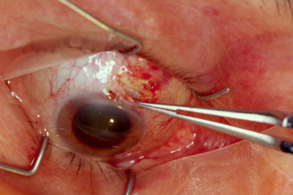 Where Do You Place Your LRI During Cataract Surgery?