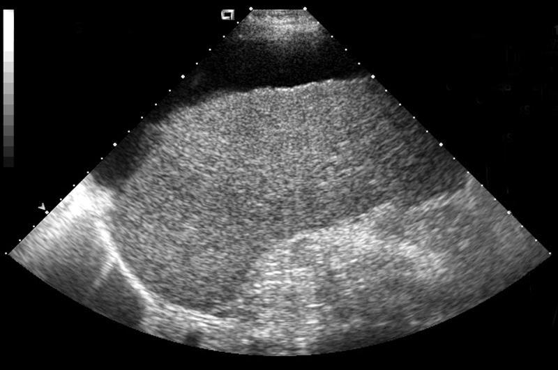 Ultrasound Often normal Thickened bile