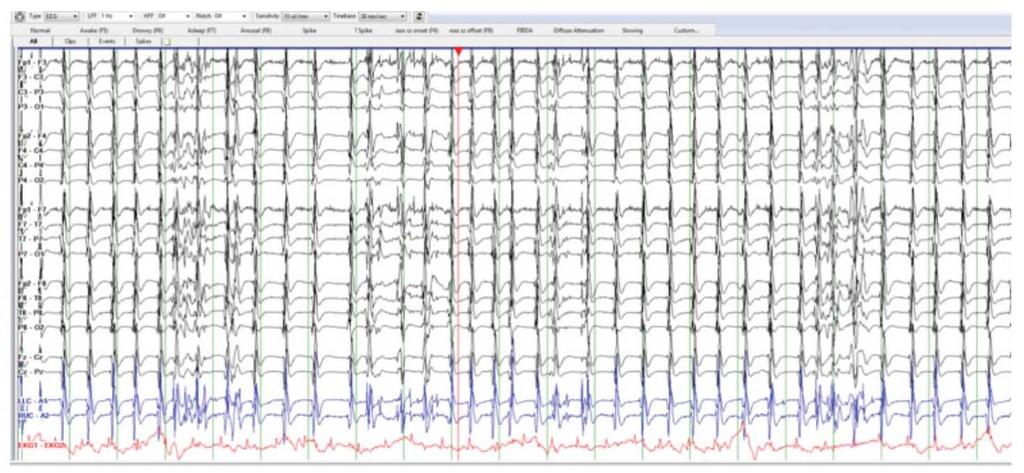 Seizures after cardiac arrest bad or fatal?