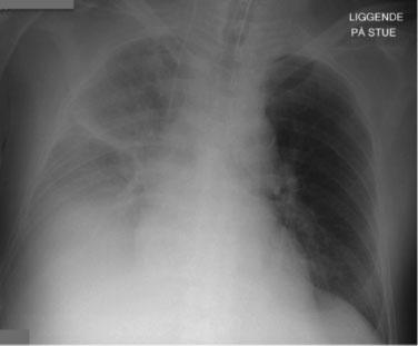 parenchymal infiltrates Compared with earlier chest X-rays: Increased size and density of infiltrate in the left upper lobe Compared with earlier chest X-rays: Increased density and area