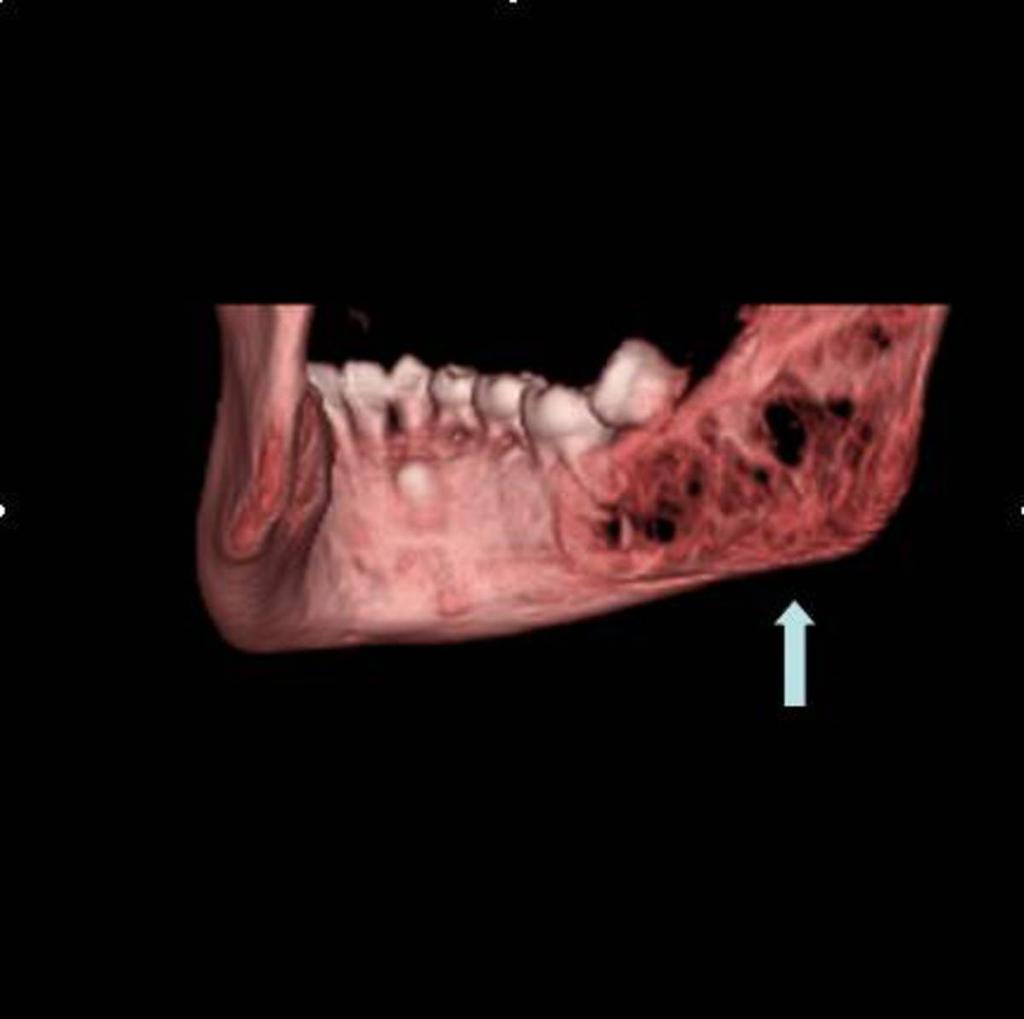 Fig. 0: 3D VR reconstruction shows in the molar-ramus region a large multilocular boneless area.