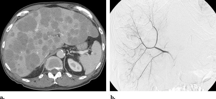 Volume 17 Number 8 Madoff et al 1245 Figure 6. Acute liver failure in a 68-year-old man with metastatic carcinoid tumor whose disease progressed despite aggressive chemotherapy.