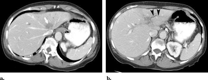 Volume 17 Number 8 Madoff et al 1241 Figure 3. Images from a 71-year-old woman with a single carcinoid lesion and carcinoid syndrome despite long-acting octreotide therapy.