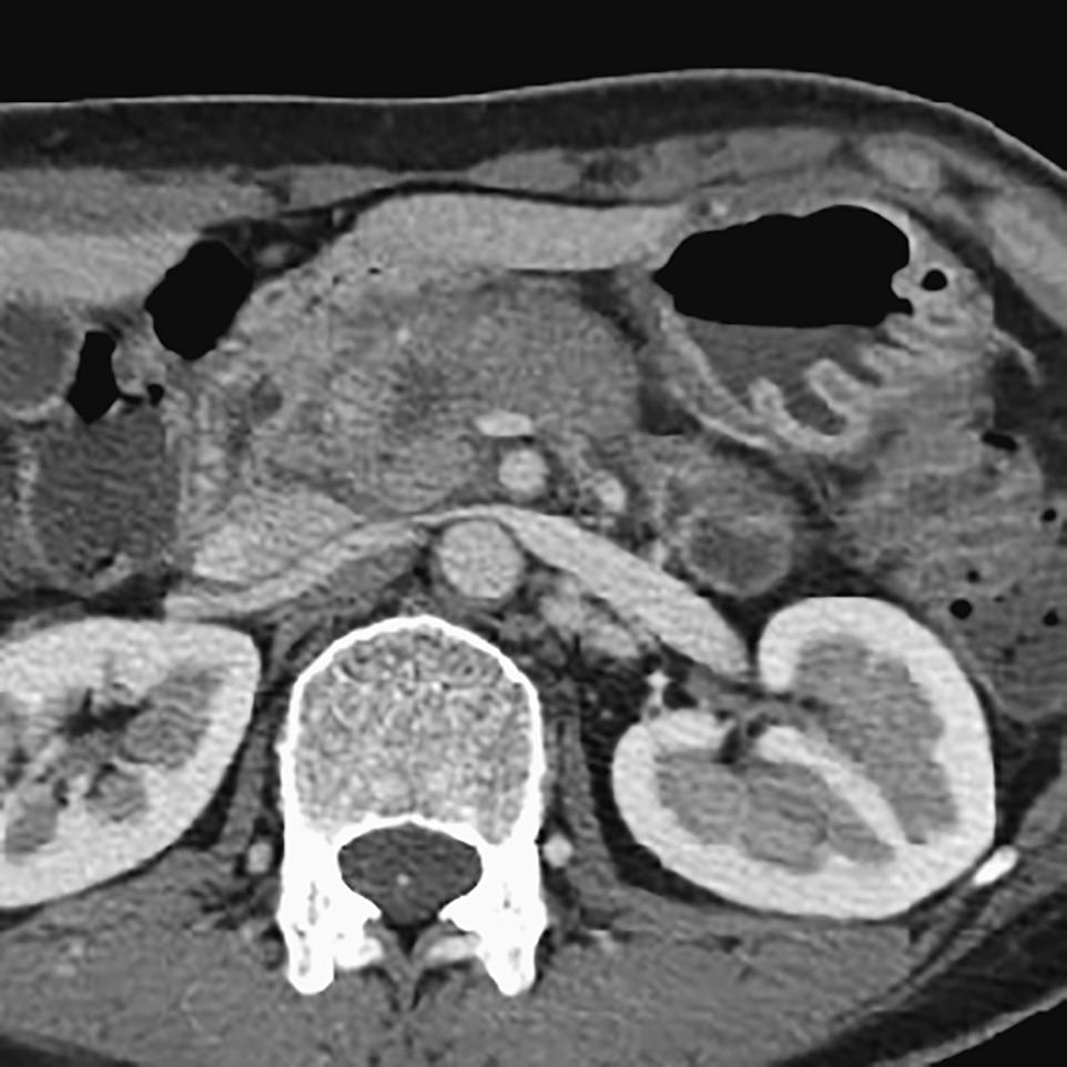 Kawakami Fujinaga Yanagisawa et al. a b Fig. 1 Abdominal CT (a) Contrast-enhanced abdominal CT shows a mass lesion at pancreatic head (arrowheads).