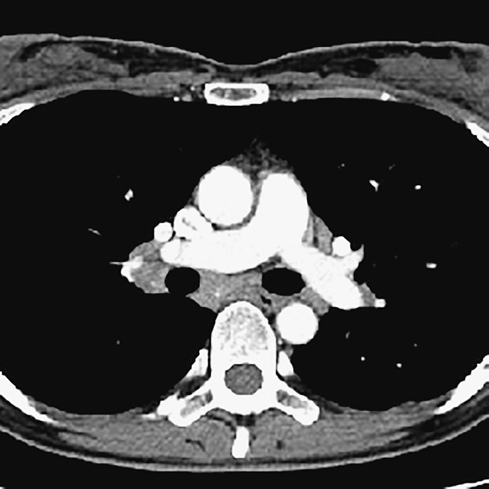 possibility was a pancreatic carcinoma complicated pancreatic mass and non-caseous granulomas in the with sarcoidosis.