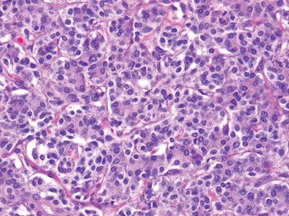 neoplasm to their normal cellular