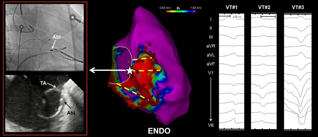 Figure 1. Typical distribution of endocardial (ENDO) ablation lesions across abnormal right ventricle to valve annuli in a patient with multiple unmappable VTs.