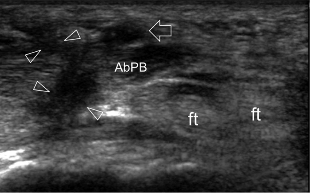 Fig. 8: Carpal tunnel syndrome.ulnar-sided origin of the TMB.