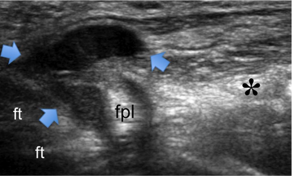 (arrow) in the opponens pollics, abductor pollicis brevis and superficial belly