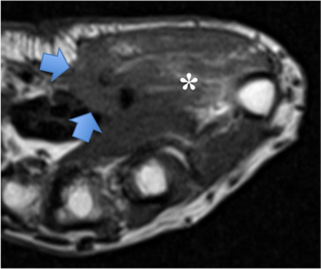 Fig. 13: Myofibroblastic tumor of the TMB.