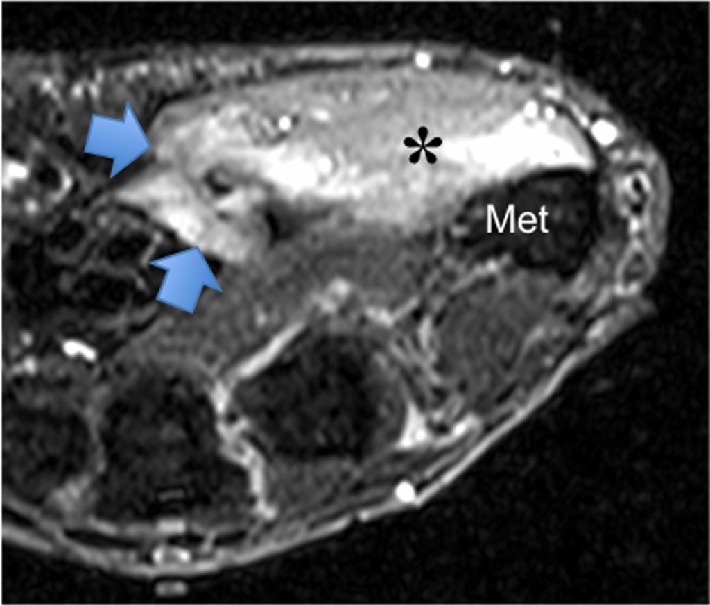 Fig. 14: Myofibroblastic tumor of the TMB.
