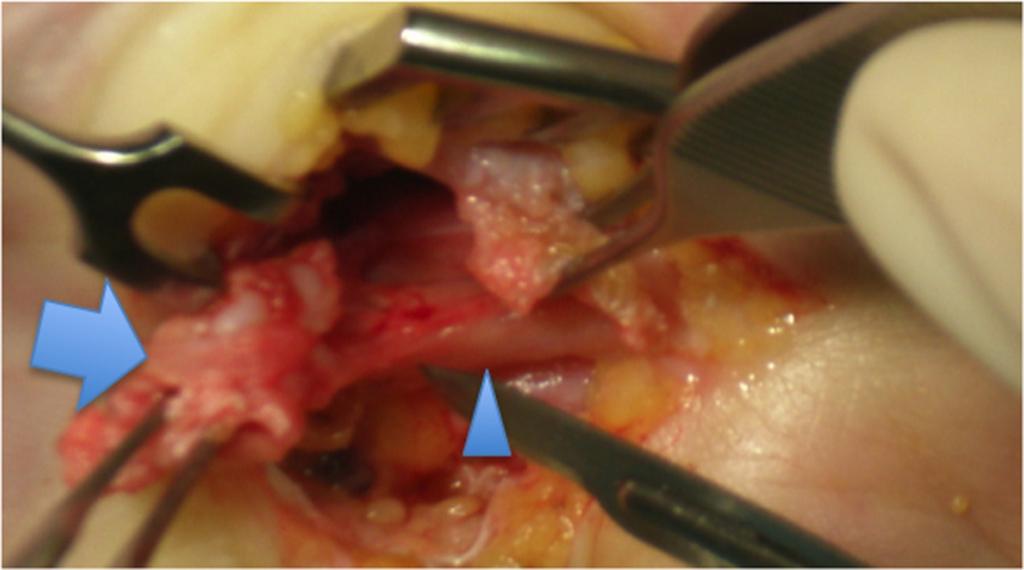 Fig. 15: Myofibroblastic tumor of the TMB.