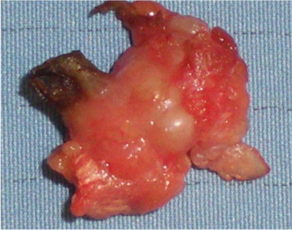 Fig. 16: Myofibroblastic tumor of