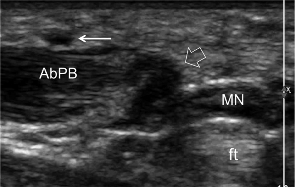 Images for this section: Fig. 3: Ultrasound anatomy of the TMB of the MN.Level of origin and vertical segment.