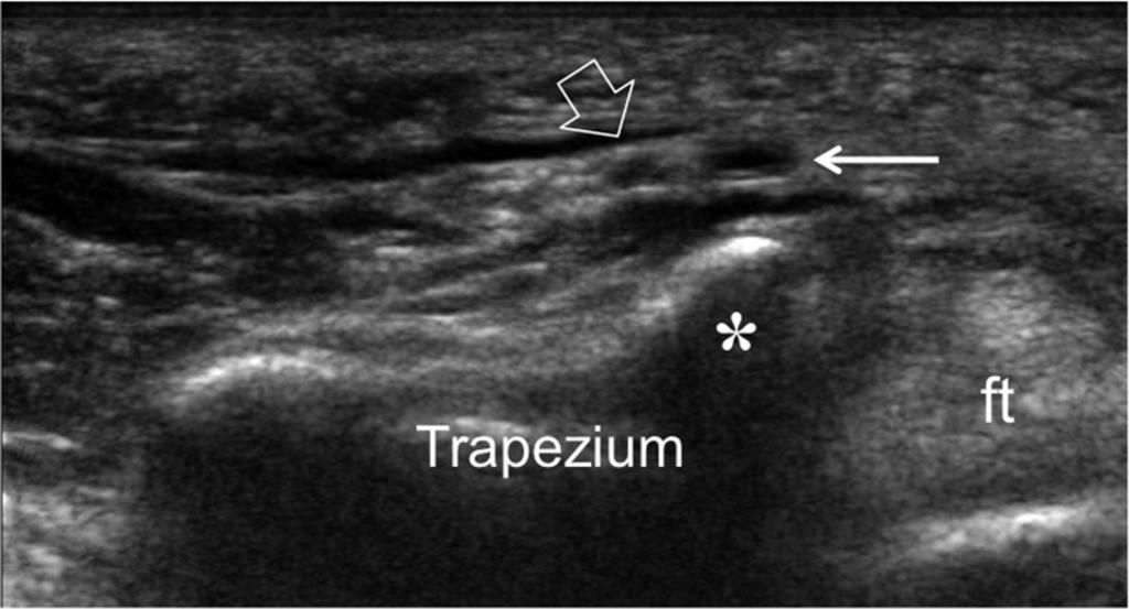 Fig. 4: Ultrasound anatomy of the TMB of the MN.Distal intrathenar segment.