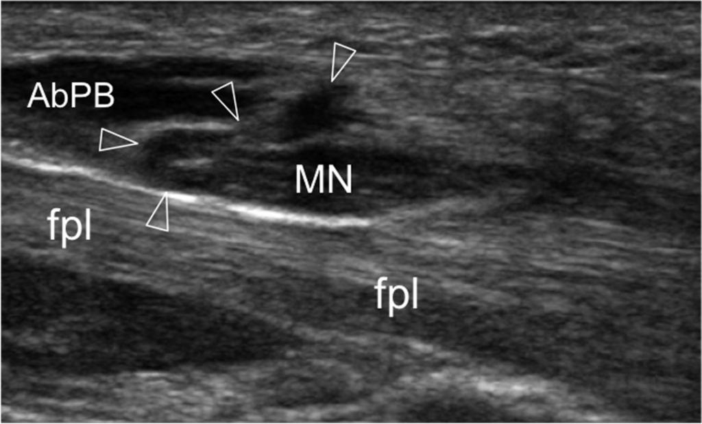 of the radial artery (narrow arrow) as they course over the tubercle (asterisk) of