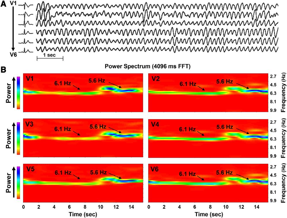 Calvo et al Frequency-Phase ECG and Substrate in Human VT/VF 1135 Figure 1. Shared frequency (SF) during ventricular fibrillation (VF) in a patient with Brugada syndrome (BrS).