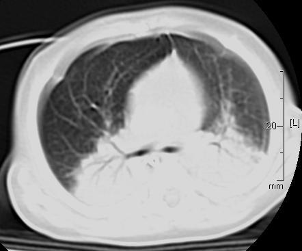 CT Scan THORAX Bilateral lower lobe consolidation with