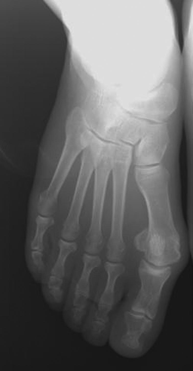 In this study, a proximal chevron osteotomy was performed in patients with severe hallux valgus deformity in whom the first-second IMA was 20º or higher.