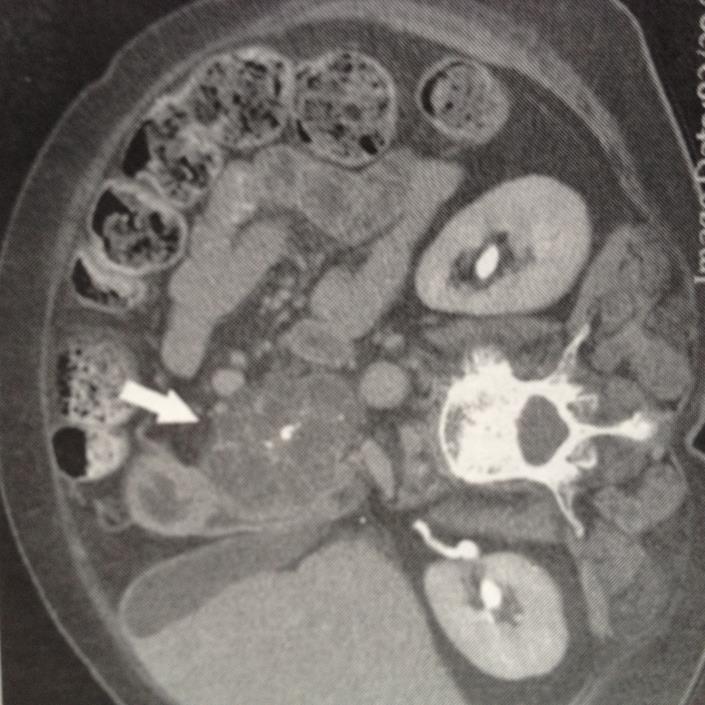 Serous Cystadenocarcinoma 3% of serous tumors Diagnosis by characteristic imaging Honeycombing 20% have a