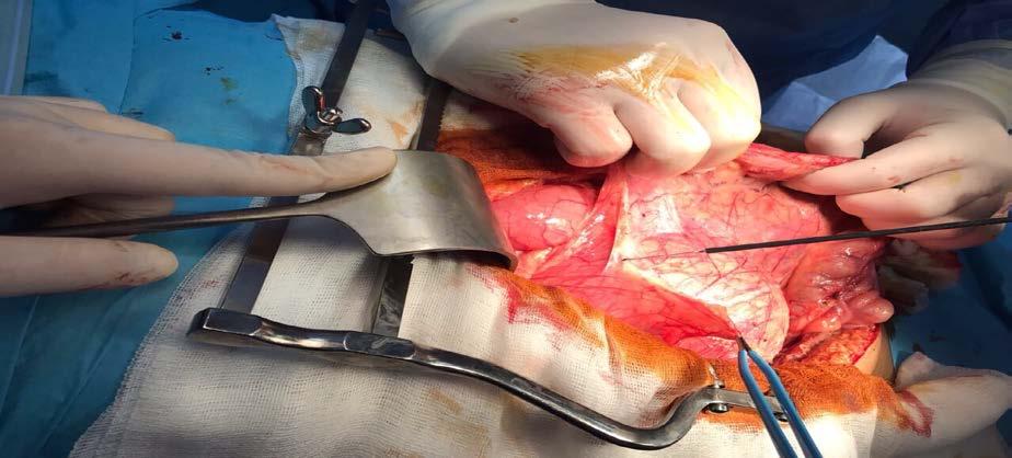 We successfully performed a salvage of the left kidney by wide excision and separated the tumor from the aorta by shaving it away,
