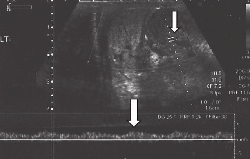 HR 2 1 3 Fig. 1. B-mode ultrasound image of the scrotum (oblique plane). Lobulated left paratesticular mass with mixed echogenicity pattern, measuring 6 cm in diameter (between arrows). Fig. 2. Triplex ultrasound image of the scrotum (sagittal plane).