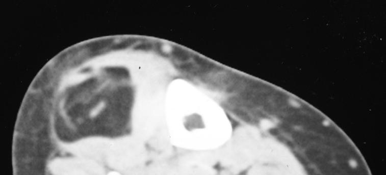92 Soft Tissue Tumors varies, and the streaks may be discontinuous.