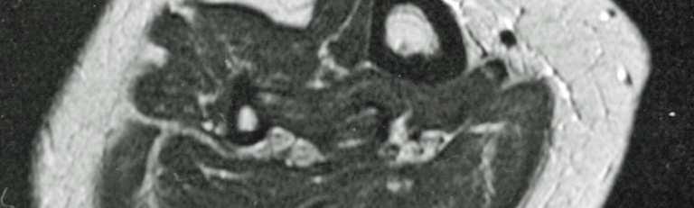 The streaky structures observed on CT macroscopically and histologically represent muscle fibers involved in the lesion, and are often difficult to separate from the lesion.