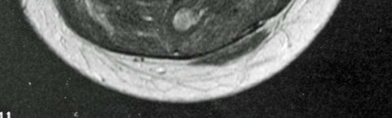 However, in approximately 15% of the cases, no streaks are observed on CT and the lesions have a capsule that allows separating easily from the surrounding muscle tissue at surgery [12].