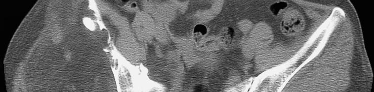 Fig. 3. A. Axial slice of computed tomography of a case with hibernoma demonstrated a fat density lesion with areas of hazy amorphous density in the medial compartment of the pelvis. B.