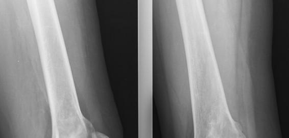 GRADE CENTRAL OSTEOSARCOMA 1-2% of osteosarcoma 50% in 2nd-3rd decade Long bones lower