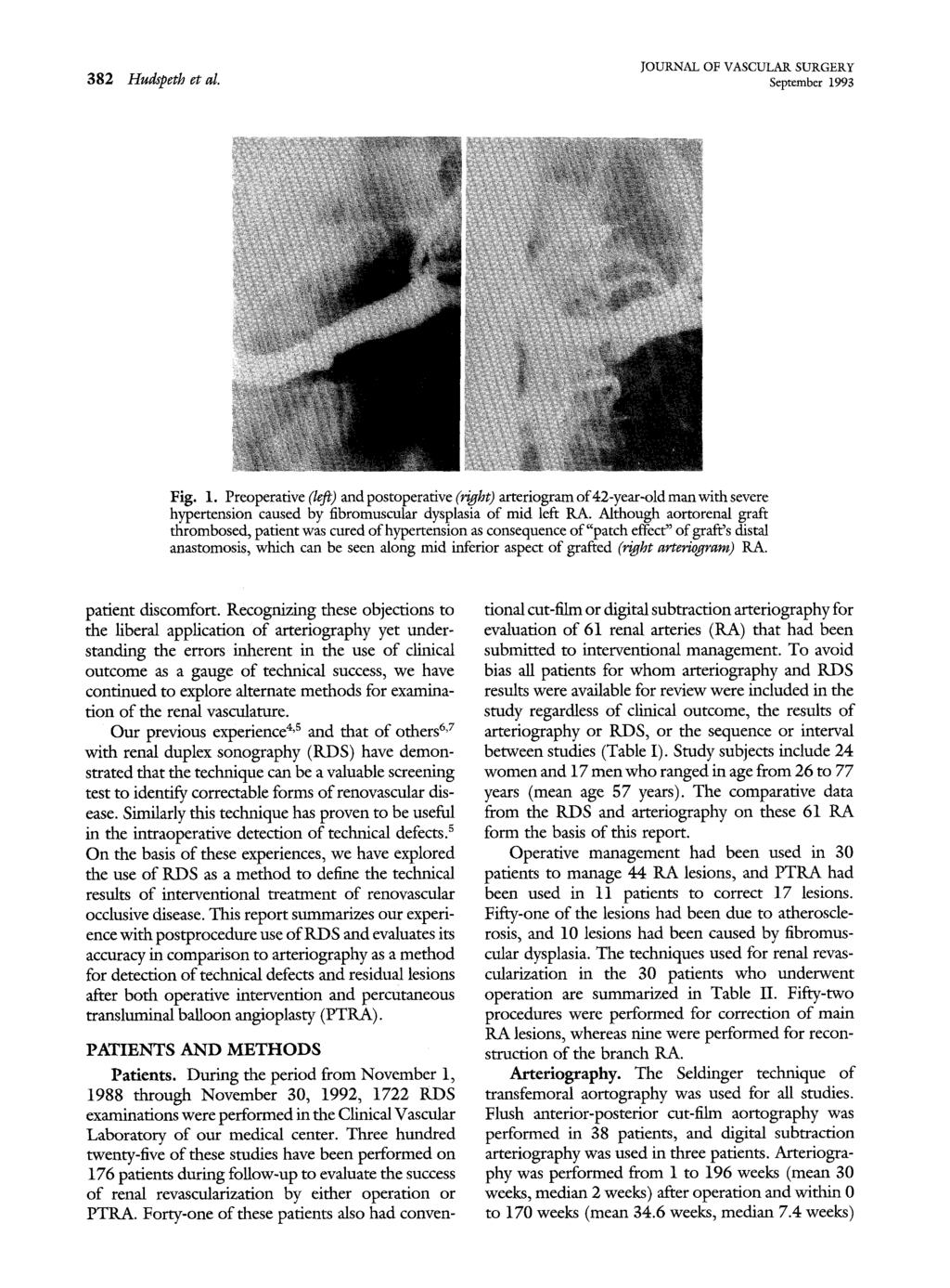 382 Hudspeth et al. September 1993 Fig. 1. Preoperative (left) and postoperative (right) arteriogram of42-year-old manwith severe hypertension caused by fibromuscular dysplasia of mid left RA.