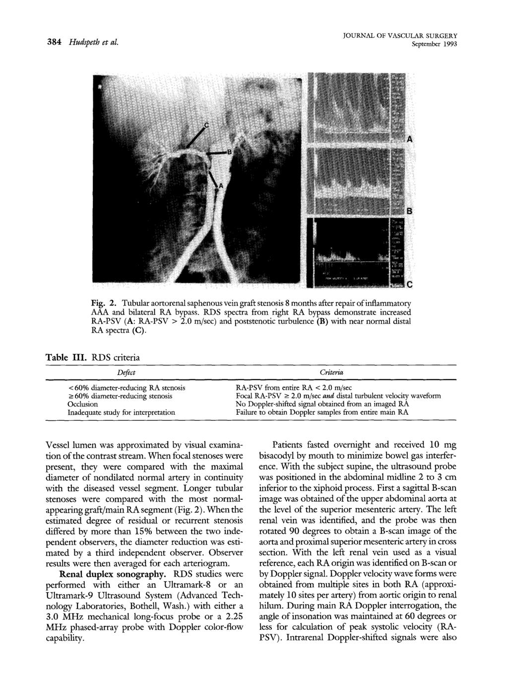 384 Hudspeth et al. September 1993 Fig. 2. Tubular aortorenal saphenous vein graft stenosis 8 months after repair of inflammatory AAA and bilateral RA bypass.