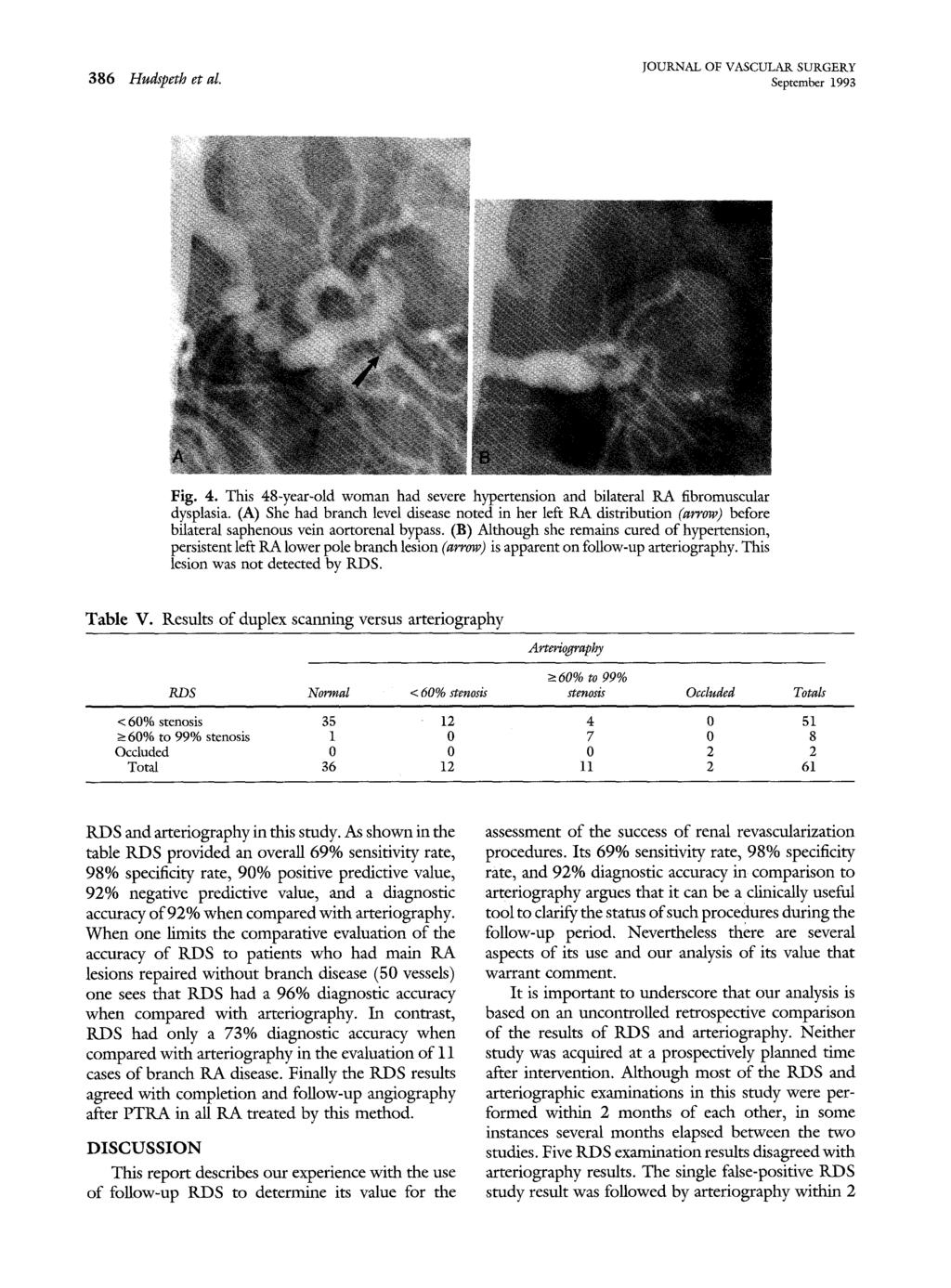 386 Hudspeth et al. September 1993 Fig. 4. This 48-year-old woman had severe hypertension and bilateral RA fibromuscular dysplasia.