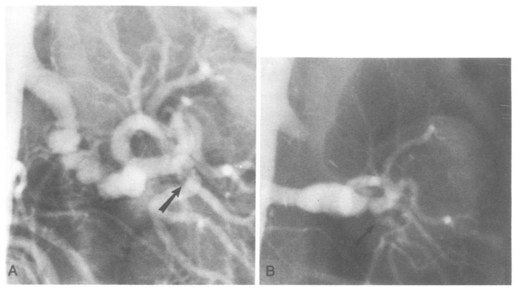 (B) Although she remains cured of hypertension, persistent left RA lower pole branch lesion (arrow) is apparent on follow-up arteriography. This lesion was not detected by RDS. Table V.