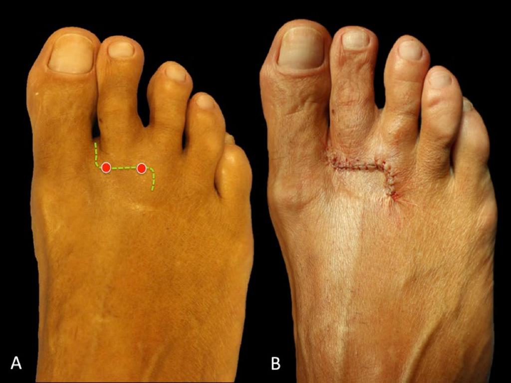 Insidious onset forefoot